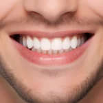 Licówki bez szlifowania w Szczecinie