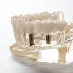 Dentysta Szczecin implanty