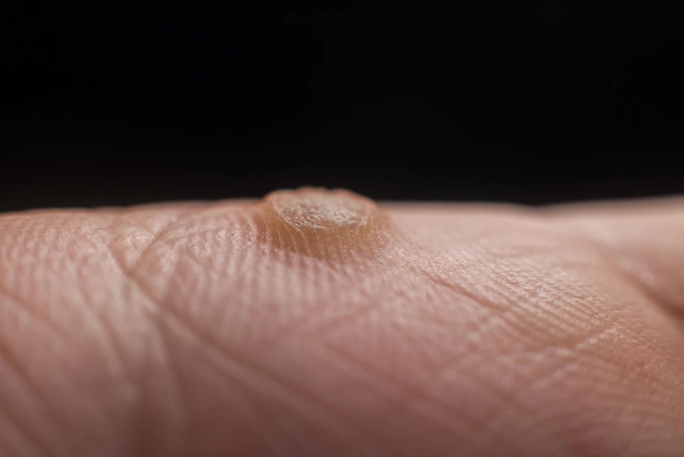 Czy kurzajki są zaraźliwe?